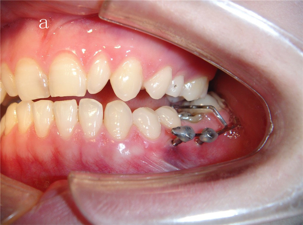 组合微螺钉种植支抗压低下颌伸长磨牙的初步研究 