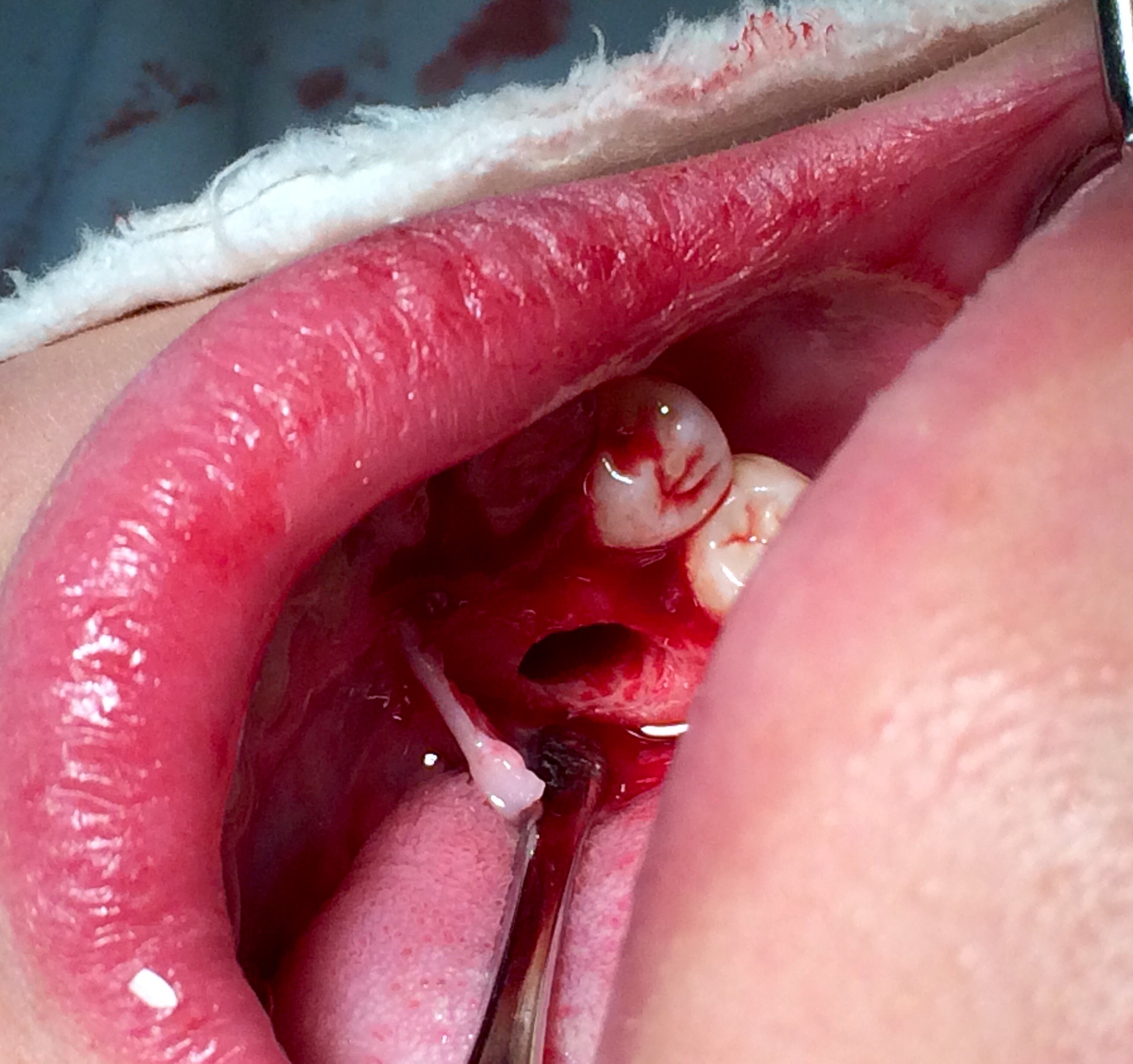 一例下颌埋伏牙舌侧开窗手术 