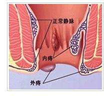 痔疮能根治吗 痔疮 疾病介绍 治疗方法