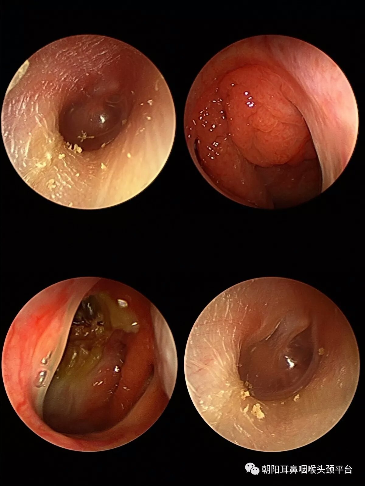 4,其他:积极治疗鼻咽部或鼻部疾病,如腺样体切除术,鼻内镜手术,咽鼓管