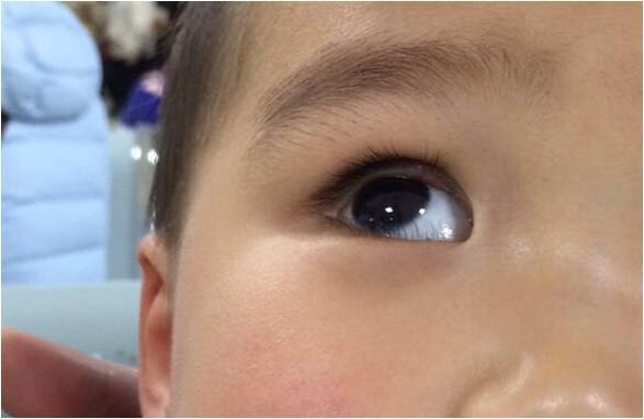 霰粒肿打针也能治愈