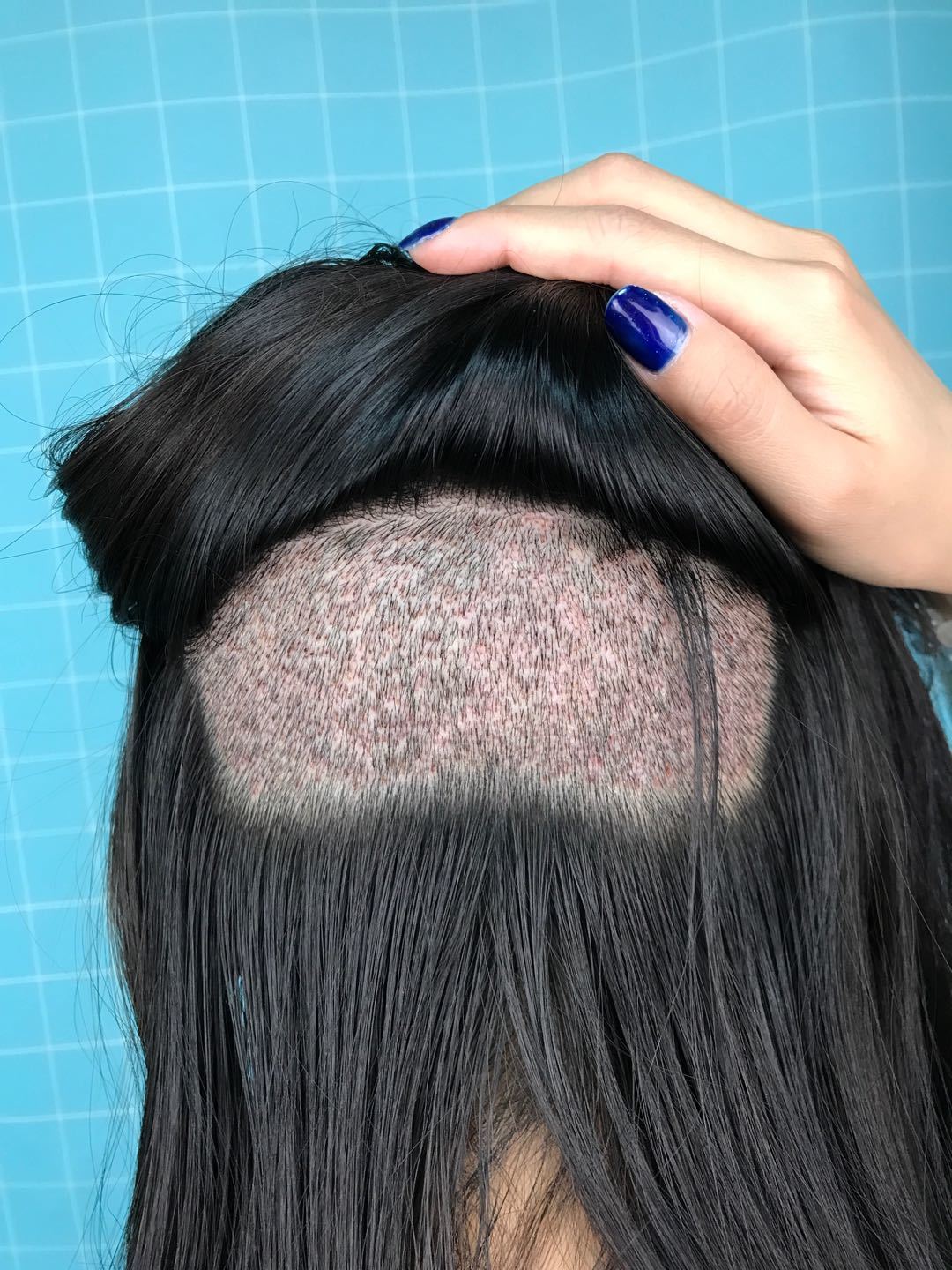 南昌种头发之后的效果科发源植发术后竟然是这样的