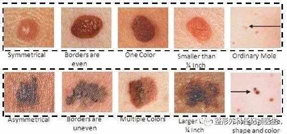 什么样的肿物需要考虑手术切除?