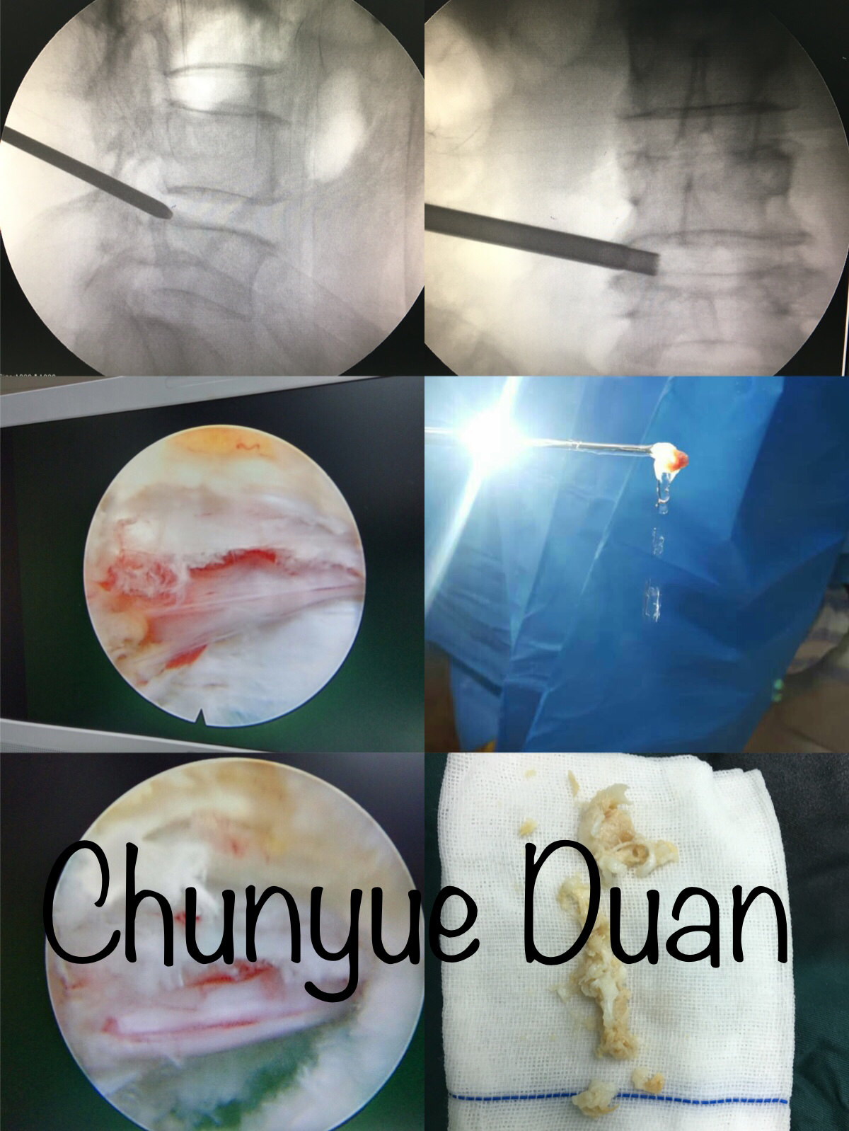 微创椎间孔镜椎间盘髓核摘除术-典型病例