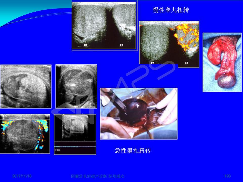 阴囊常见病超声诊断之二