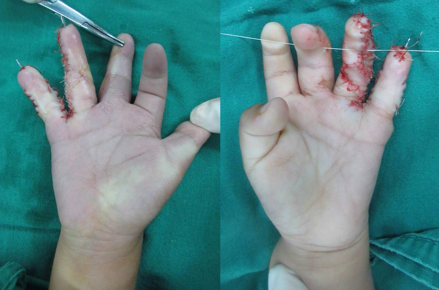 先天性并指多指畸形典型病例(手术实例) - 好大夫在线