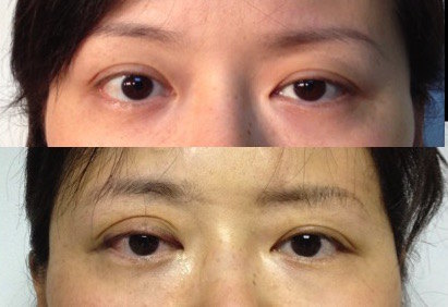 甲亢眼睑退缩手术对比图片