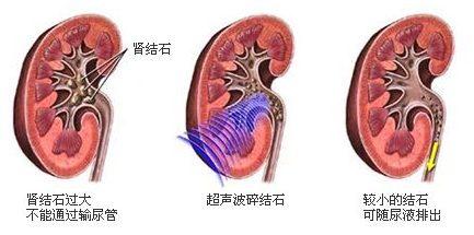 體外衝擊波碎石術的方法,不開刀,無痛苦,不住院,讓結石變小自行排出