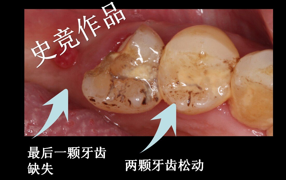 史競作品-後牙即刻種植 - 好大夫在線