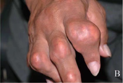 你所不知道的痛风之四上眼睑的痛风石