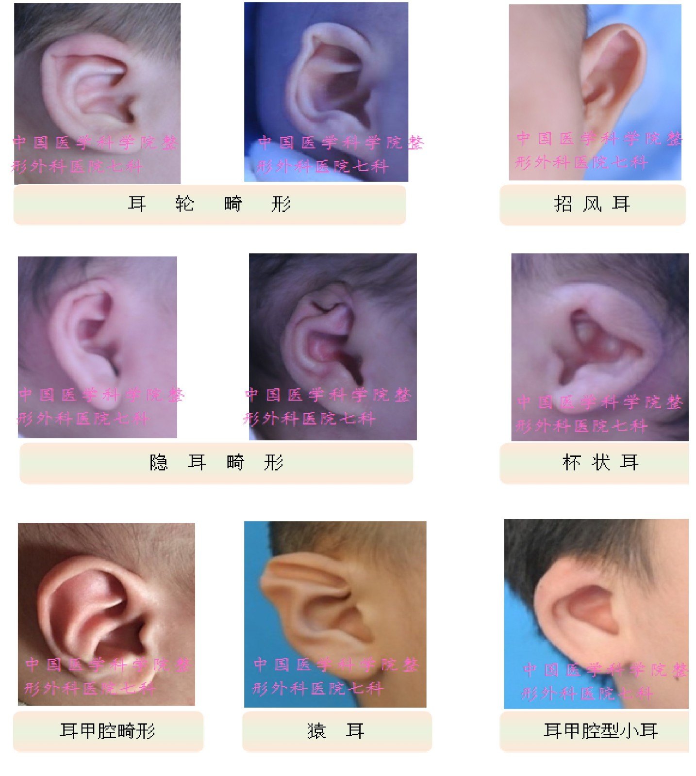 非手术治疗耳廓畸形 ——益耳矫形器