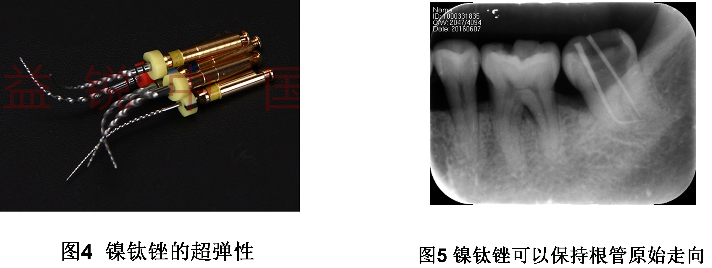 根管治疗科普问答3使用镍钛锉进行根管预备的好处