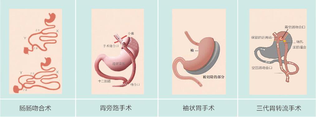 体重超过多少才能做袖状胃手术减肥吗