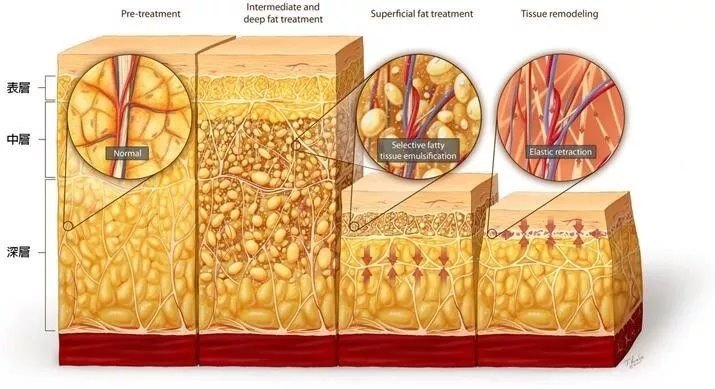 皮下脂肪通常分為三層:皮下固有脂肪層,淺層脂肪層,深層脂肪層.