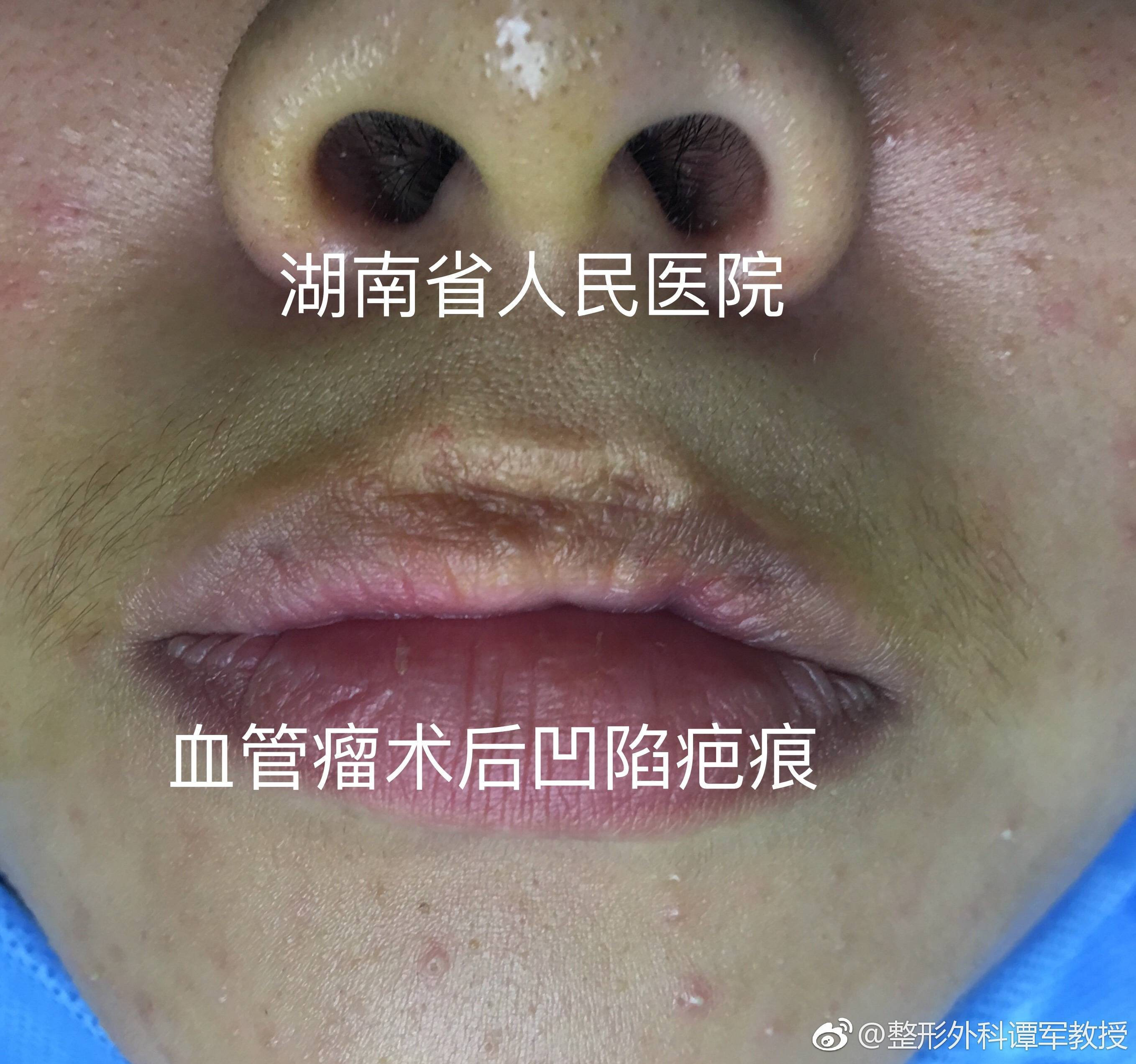 脂肪胶 脂肪注射移植 脂肪胶 脂肪注射移植