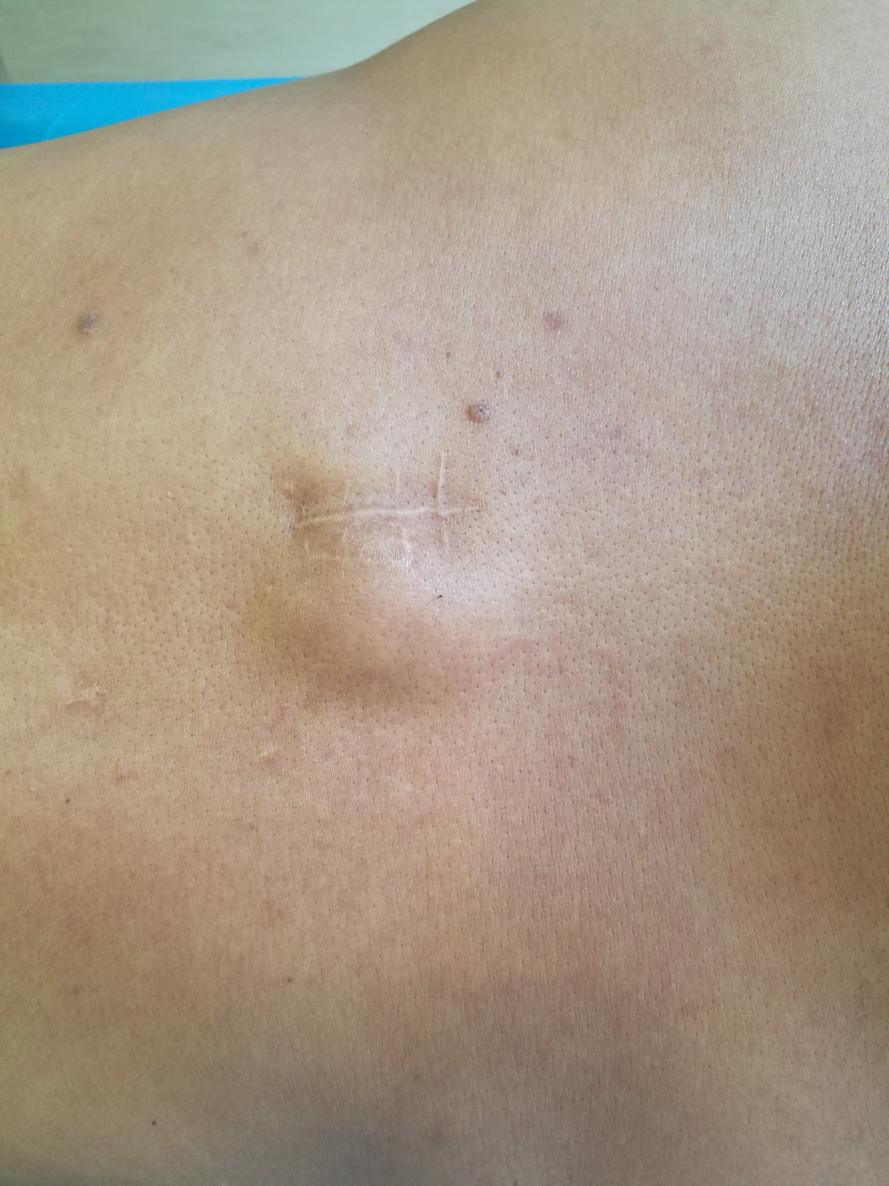 背部肿瘤图片图片