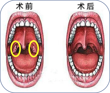 扁桃体手术要不要全切你还在纠结