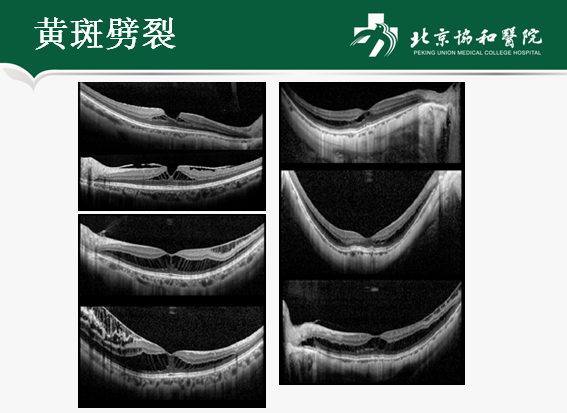 黄斑劈裂则是视网膜神经上皮层内的不完全分离,并没有产生中断,病变较