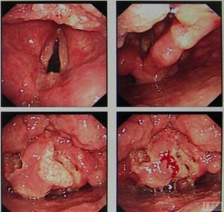 声嘶与喉癌:喉癌的早期表现