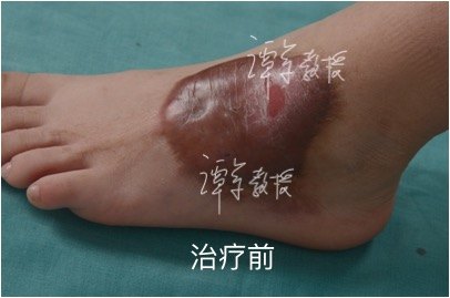 肥厚性疤痕的激光治疗