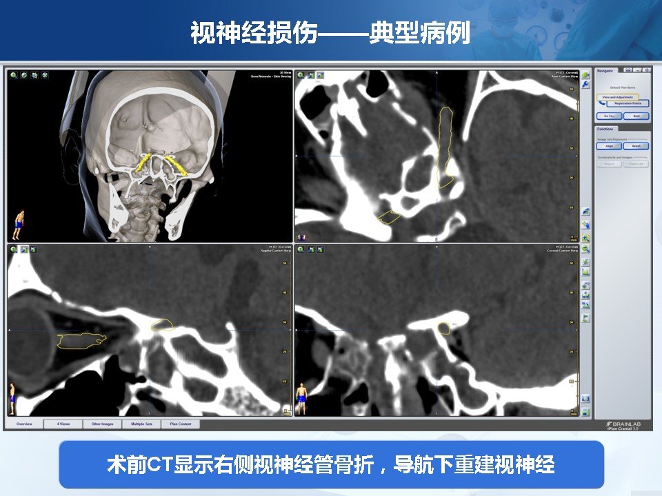 视神经损伤的内镜手术治疗 - 好大夫在线