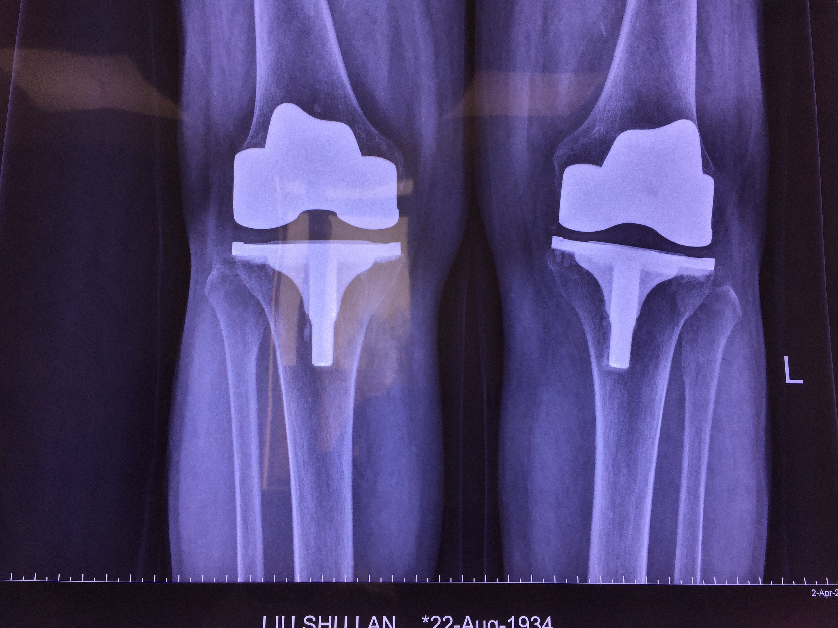 2003年行双膝关节置换 15年后假体固定良好本文是李锋版权所有,未经