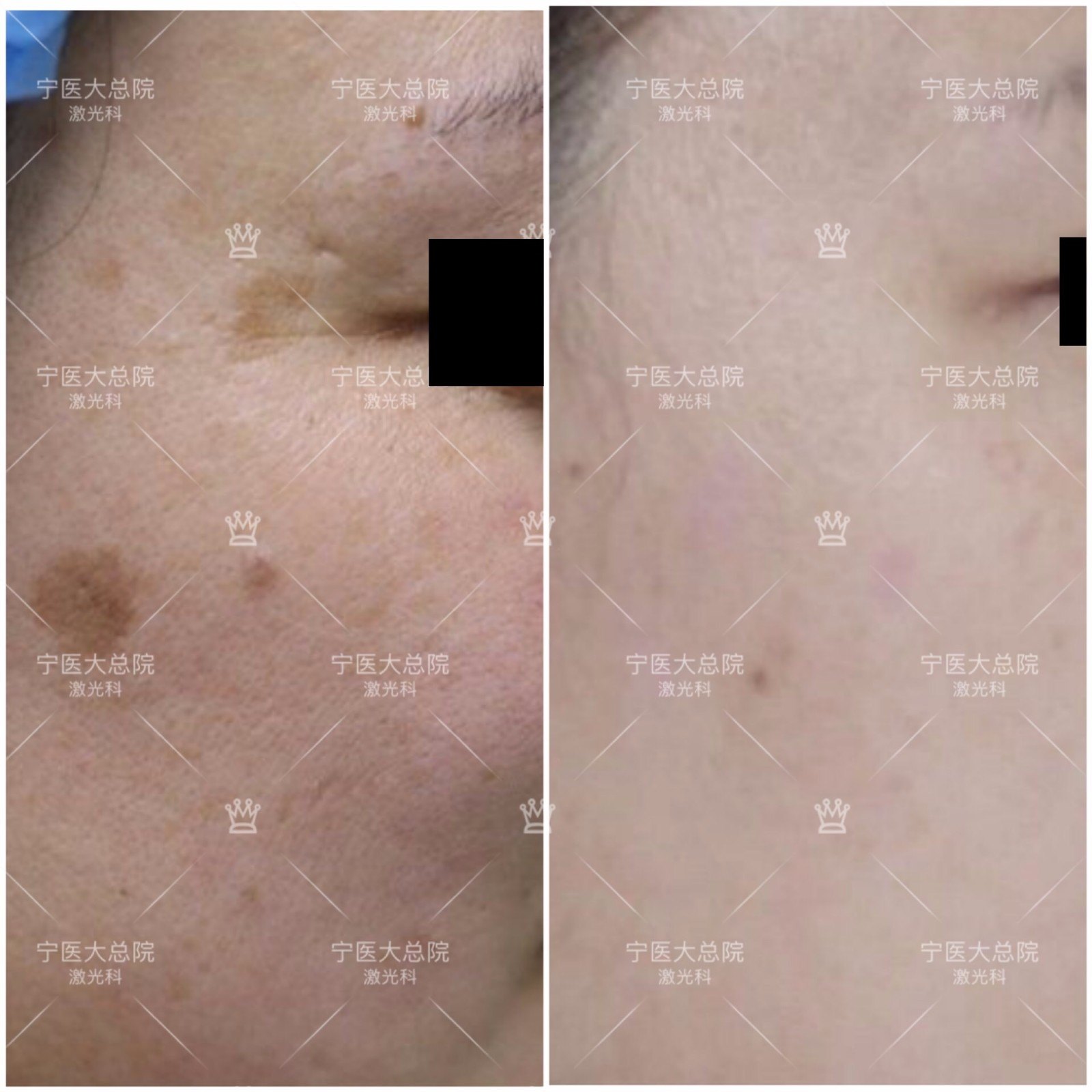 "晒斑"的治疗 - 好大夫在线