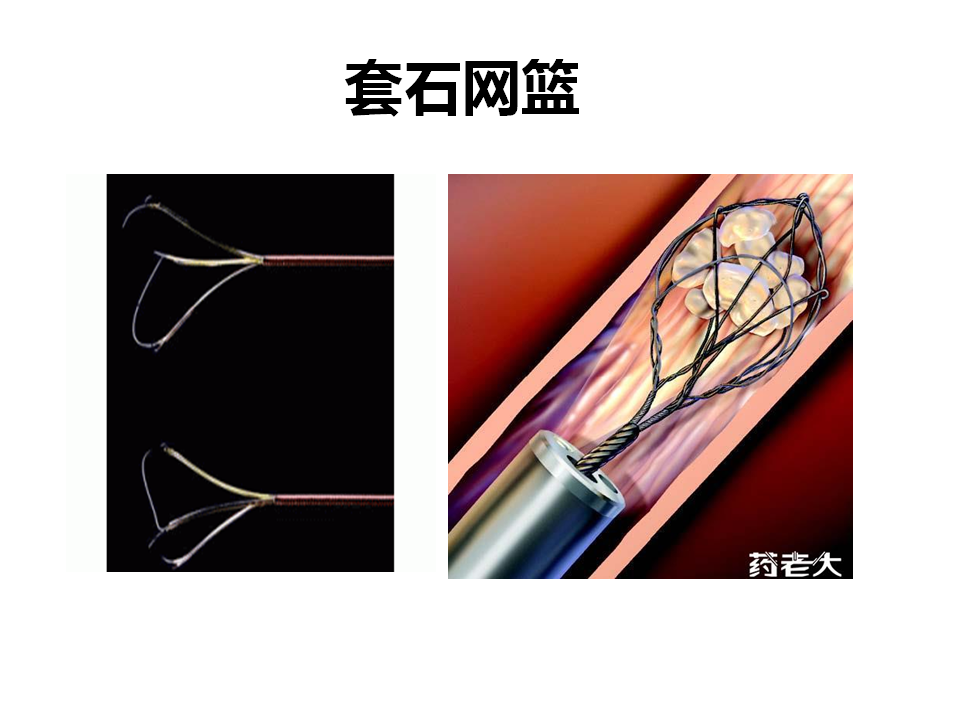 输尿管中上段结石需要使用封堵器防止结石回退肾脏(精华) - 好大夫