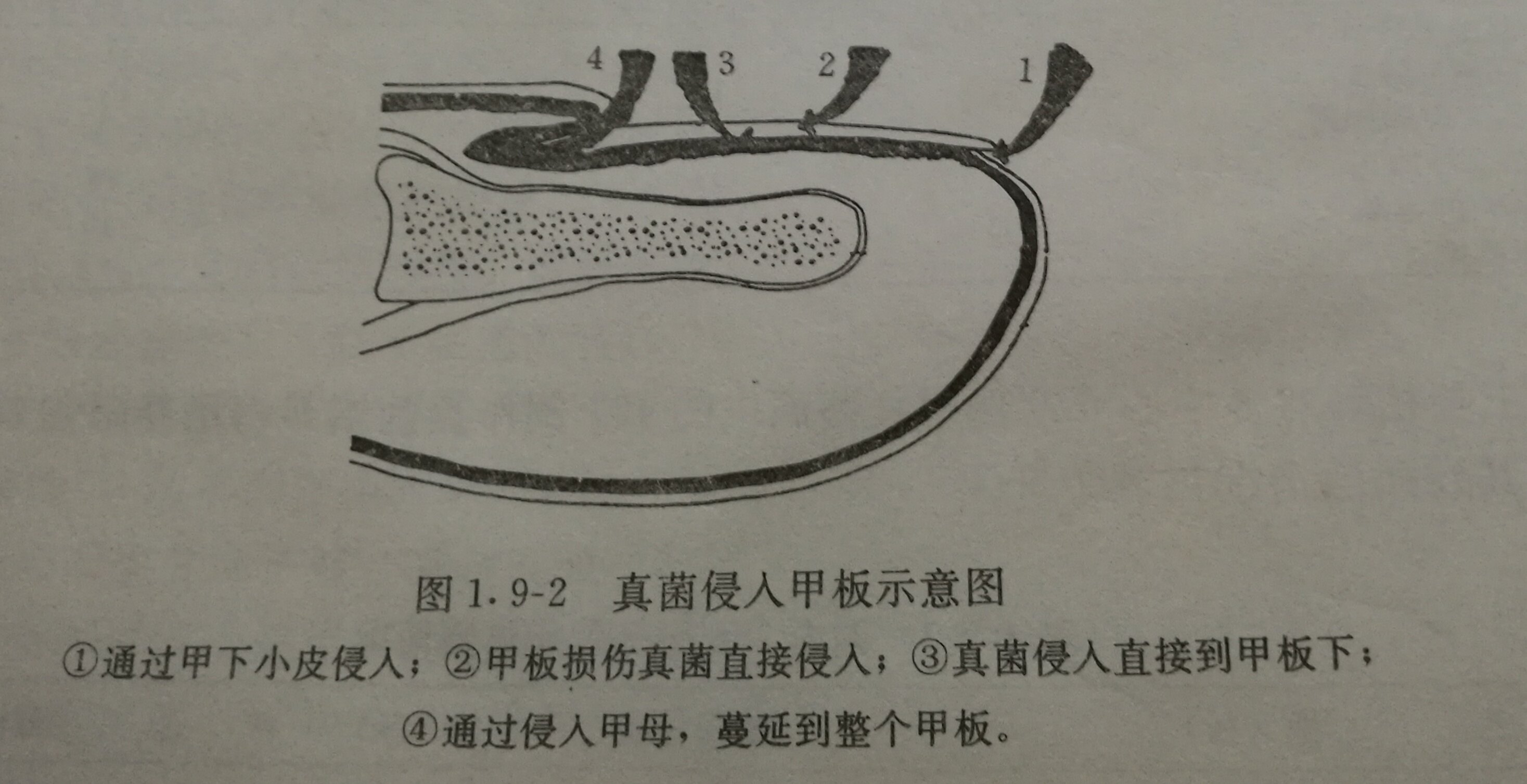 甲癣(甲真菌病)的诊断与治疗_灰指甲_疾病介绍_治疗方法_介绍_治疗