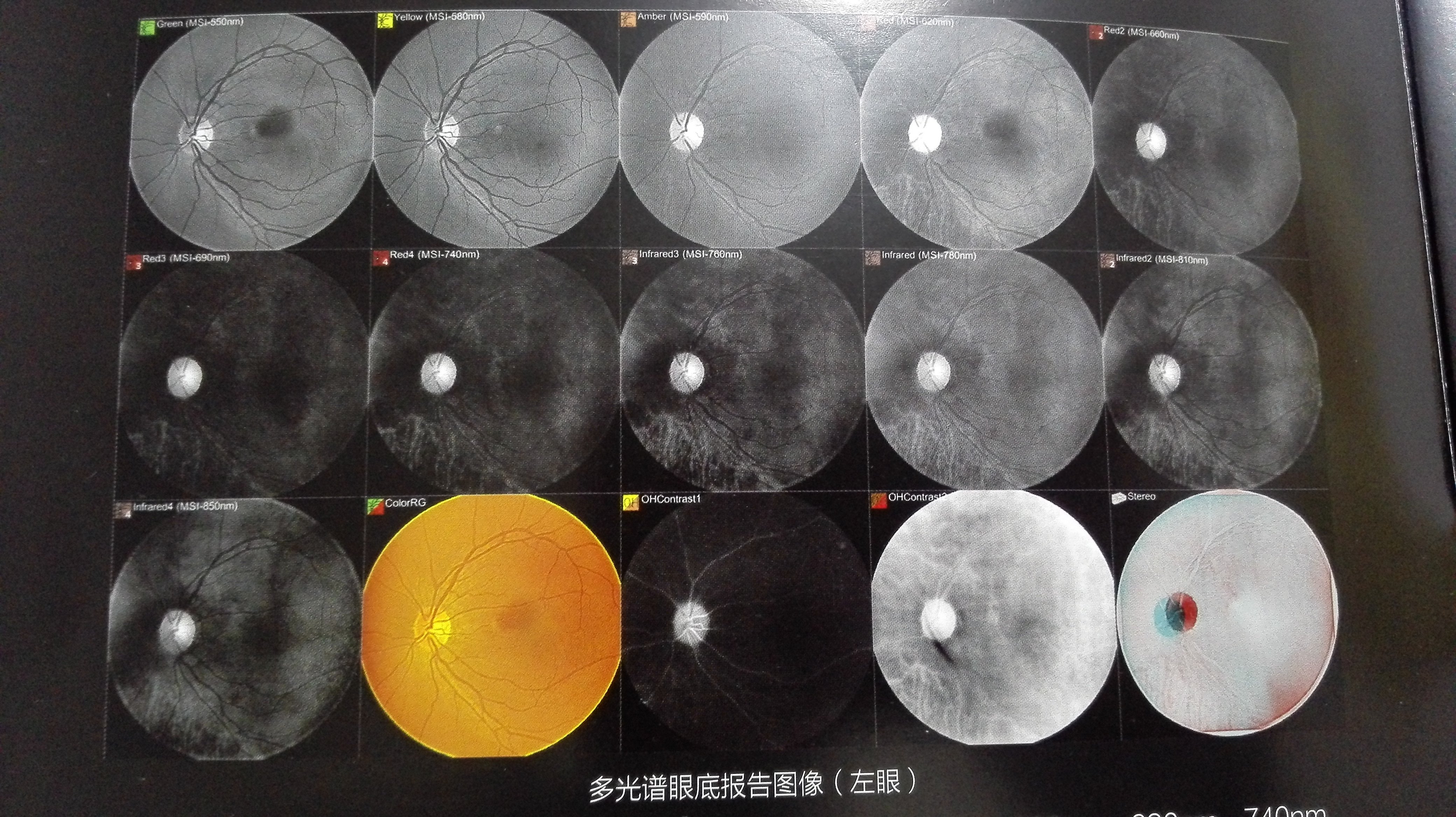 多光譜眼底檢查設備的春天