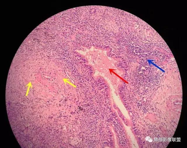 肺脓肿病理图图片