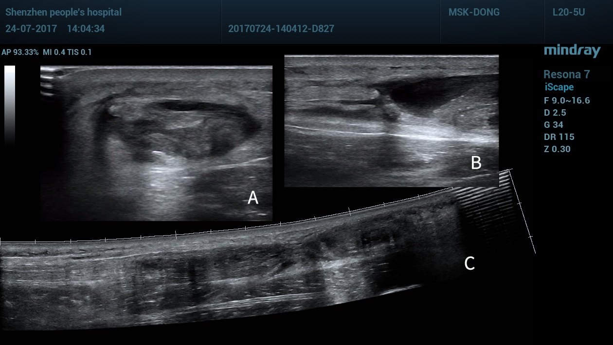 超声评估跟腱断裂应注意区分部分还是完全断裂,断端有无回缩,远端断端