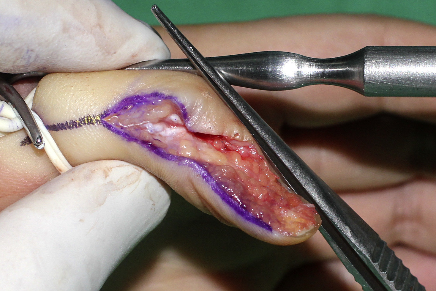 多指手术做成这样,你能接受吗? - 好大夫在线