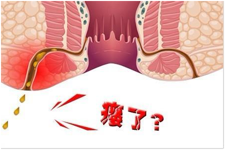 為什麼得了肛瘻就一定要手術?