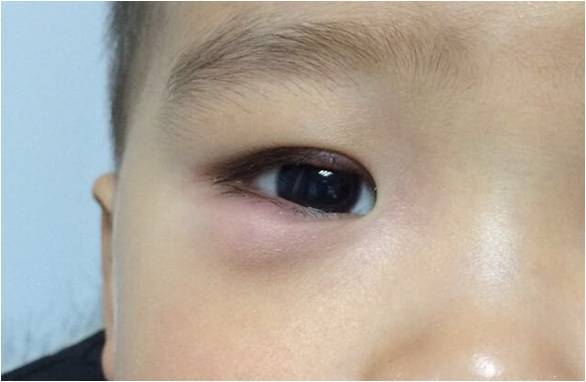 霰粒肿打针也能治愈