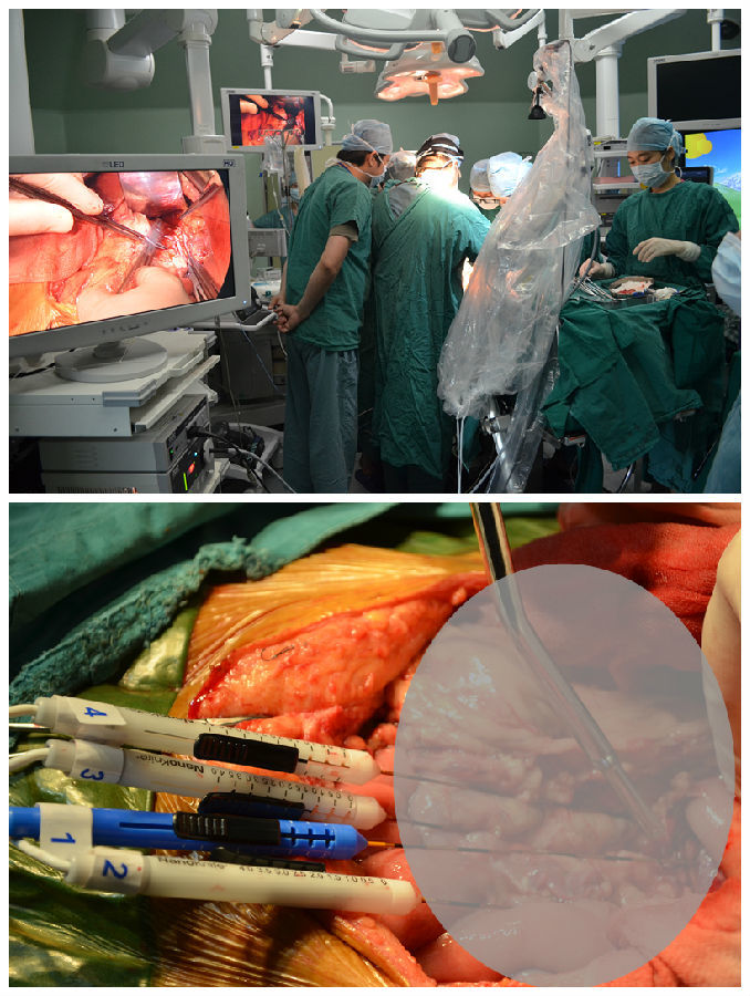 纳米刀消融,局部晚期胰腺癌的克星--中山二院的纳米刀经验 - 好大夫