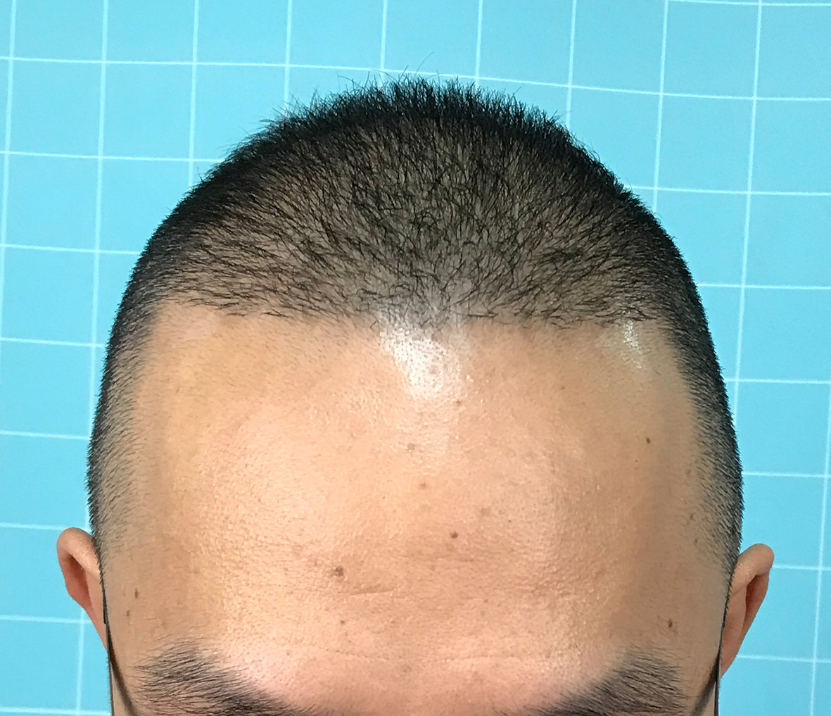 植发术后竟然是这样的.