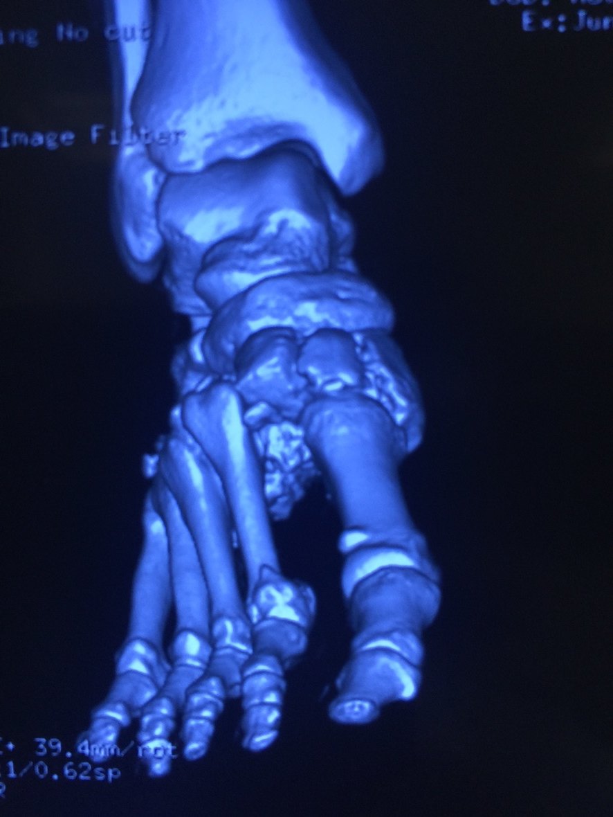 足部严重损伤骨折关节脱位lisfranc损伤