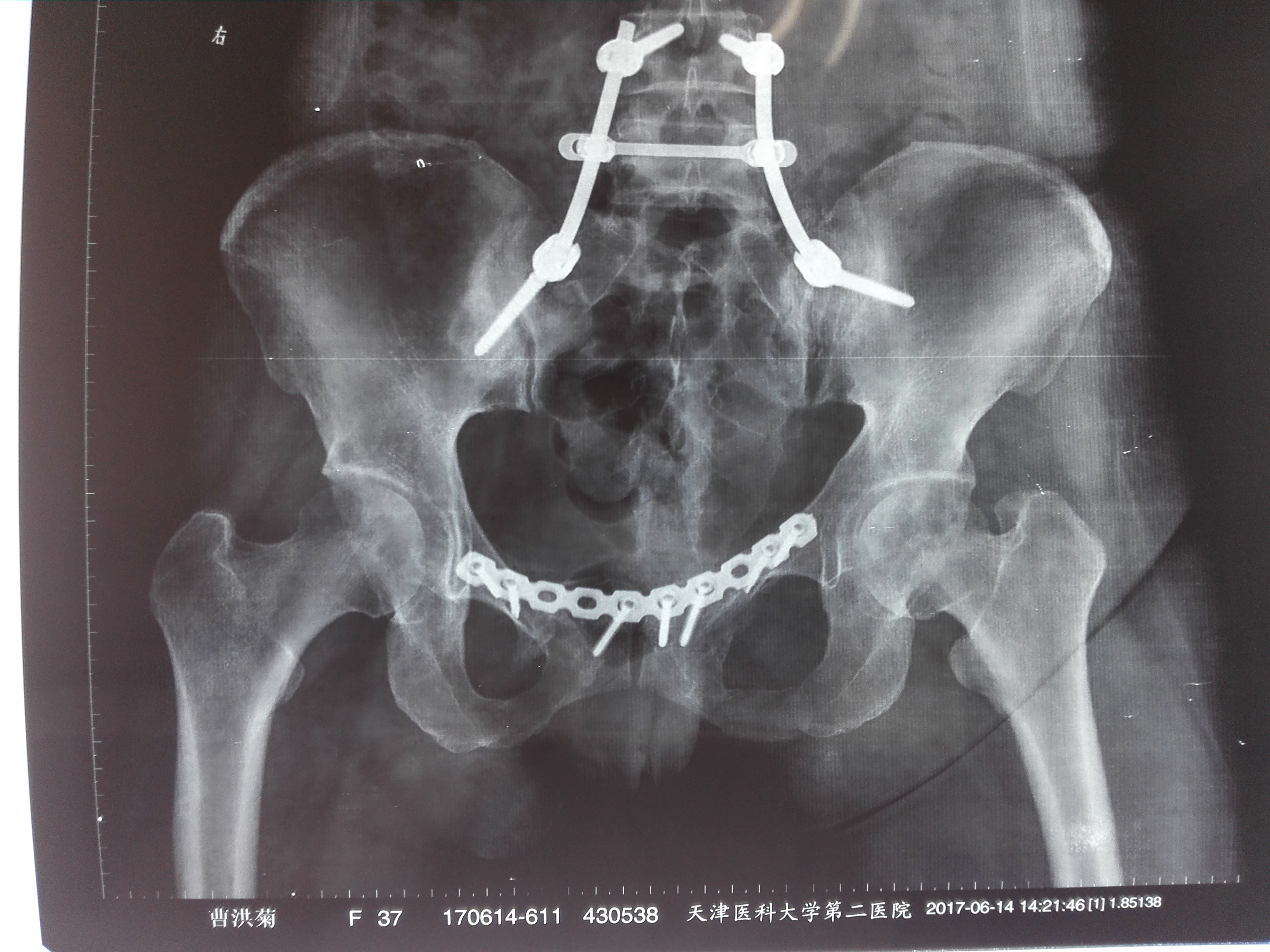 骨盆c型骨折,左侧髂骨上移3cm