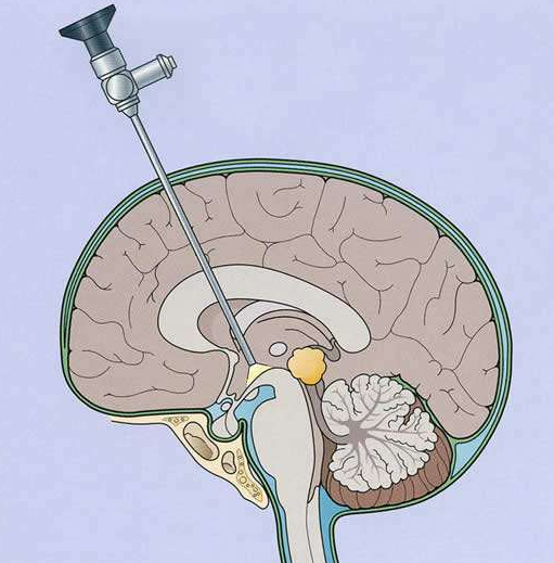 腦積水只能做腦室腹腔分流嗎