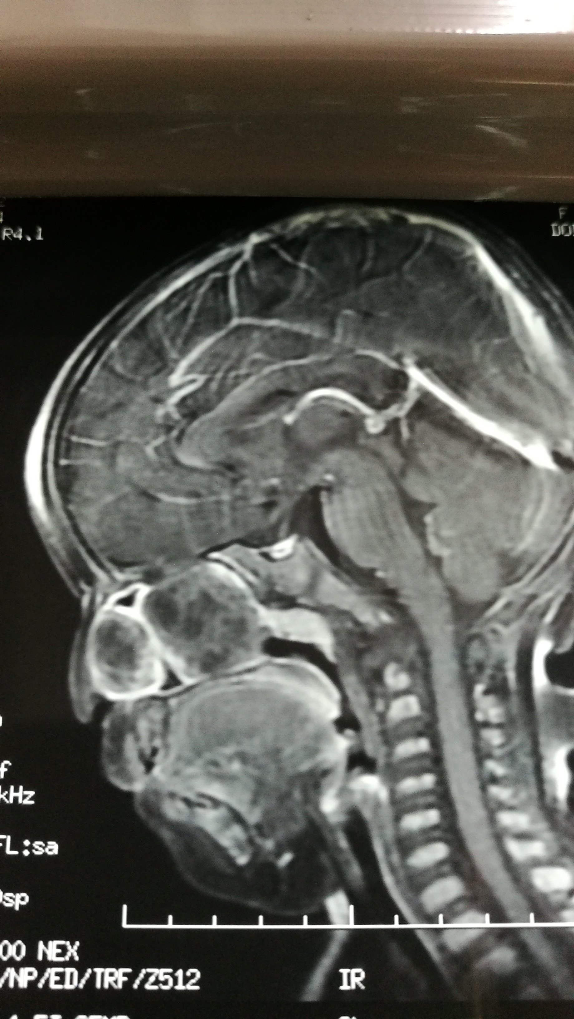 术前核磁共振见鼻腔占位本文是张维天版权所有,未经授权请勿转载.