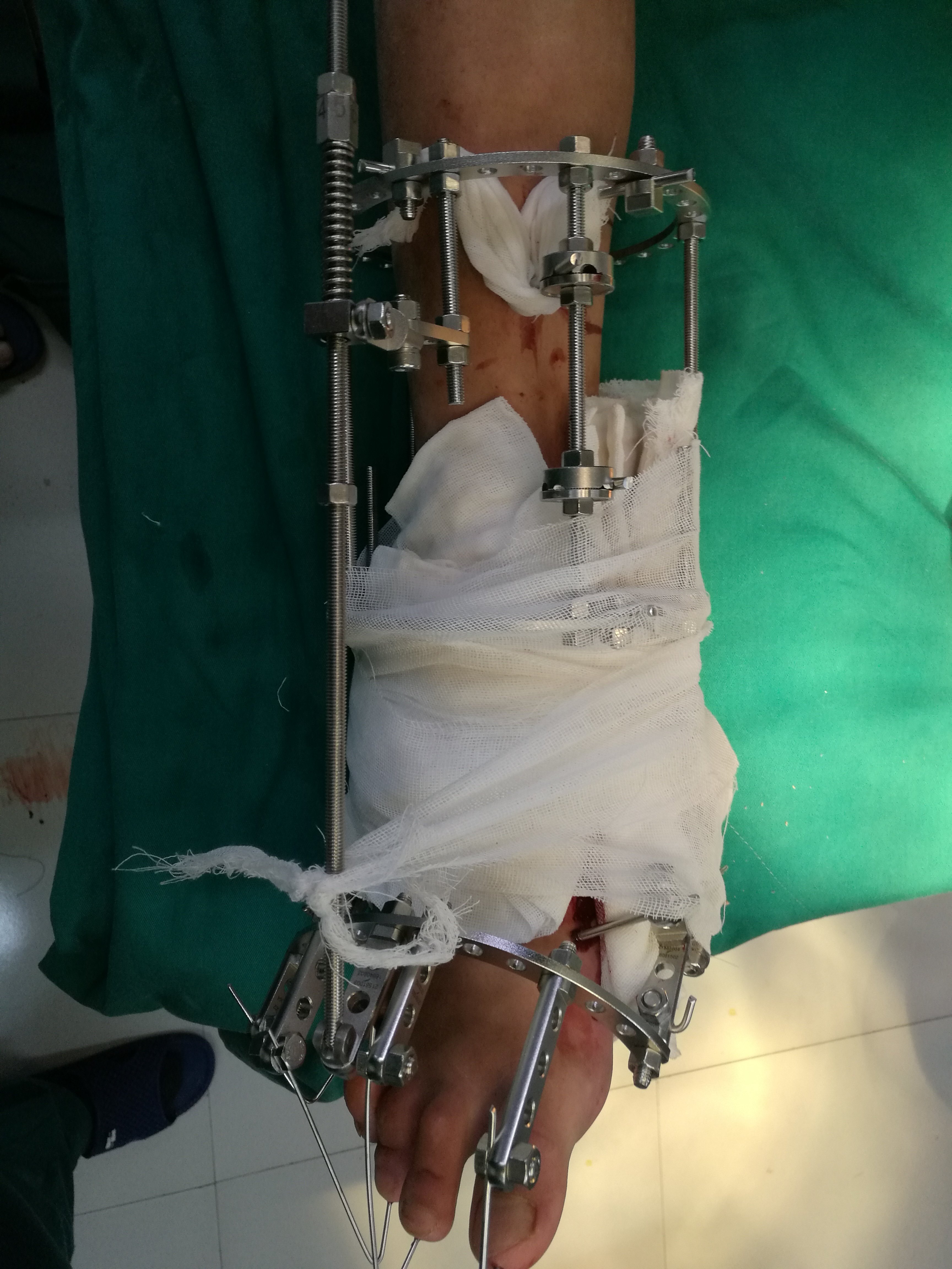 三关节截骨,融合,胫前肌腱重建足外翻畸形,ilizarov外架固定,调节高弓