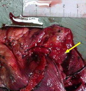 肺磨玻璃结节ggo可怕还是实性结节可怕