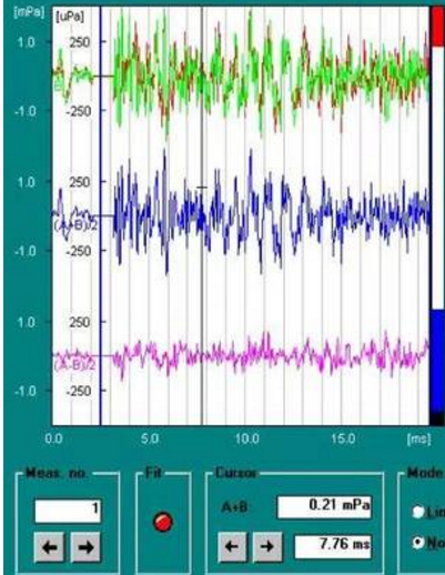 受到环境噪声和耳朵本身的影响,所以目前大部分医院采用的都是dpoae