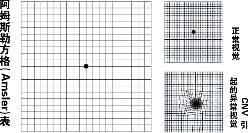 阿姆斯勒(amsler)方格表的使用 - 好大夫在线
