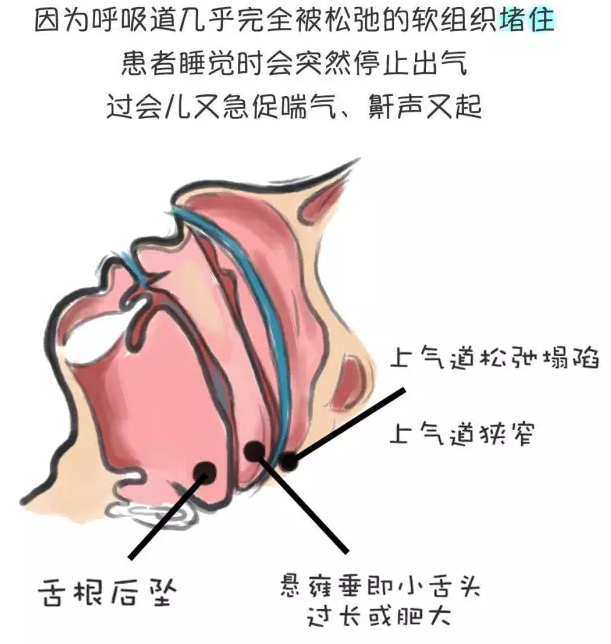 打鼾原理图片