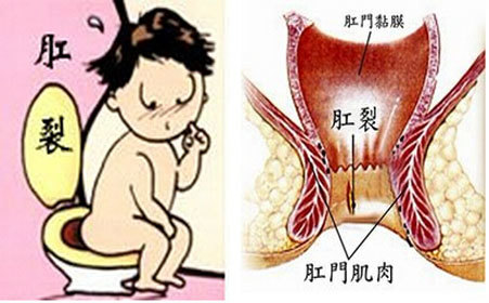 肛门裂口图片 裂开图片