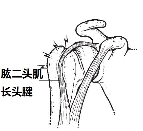 我肩肱二头肌长头腱体格检查yergason实验阳性是啥?