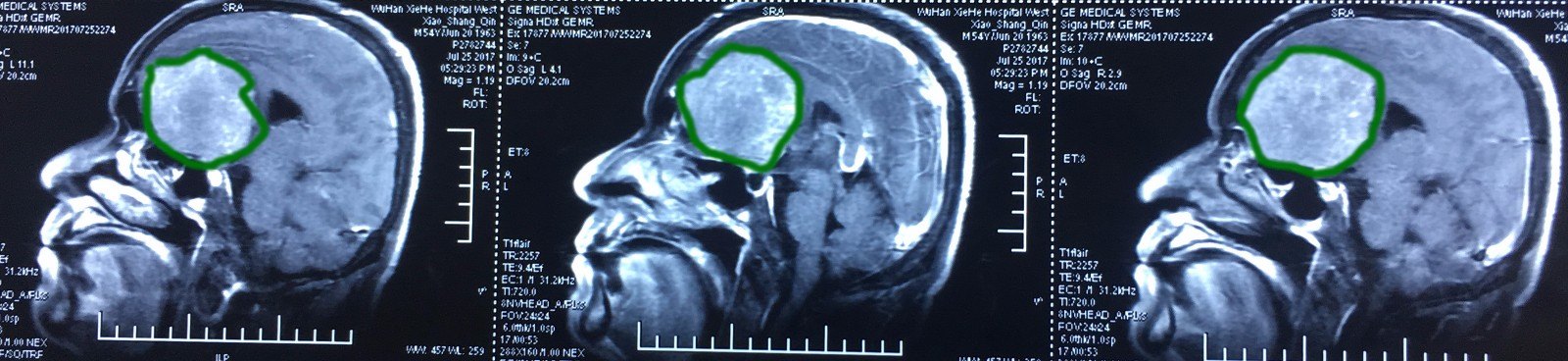 前顱窩底超級巨大腦膜瘤直徑9cm顯微外科切除