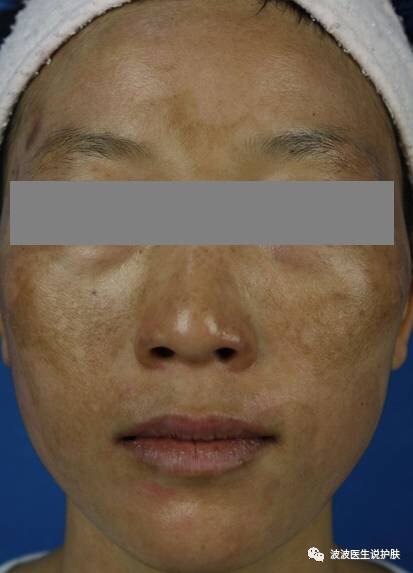 如何去除黄褐斑 黄褐斑的分类型论治 如何去除黄褐斑 黄褐斑的分类型论治